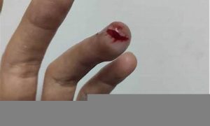 梦到自己手被割破流血(女人梦到自己手被割破流血)-命理之家