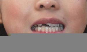 梦到门牙掉了(梦到门牙掉了没出血是什么意思)-命理之家